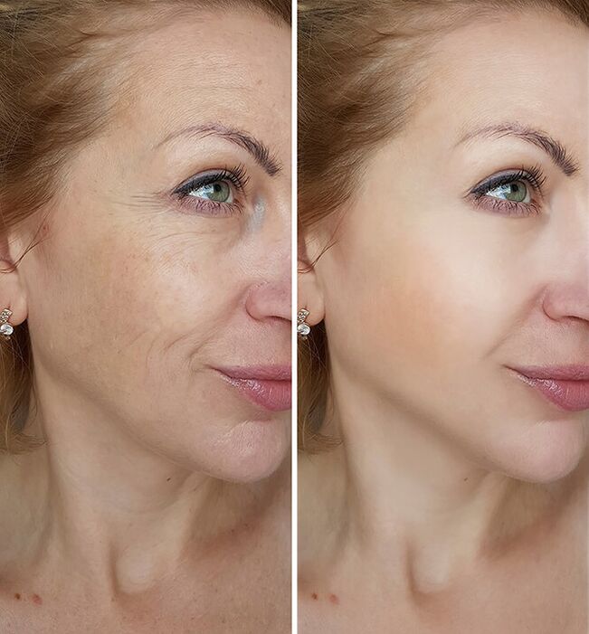 How Yenki Derm rejuvenated Mary of Krakow