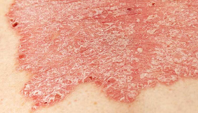 psoriatic plaque