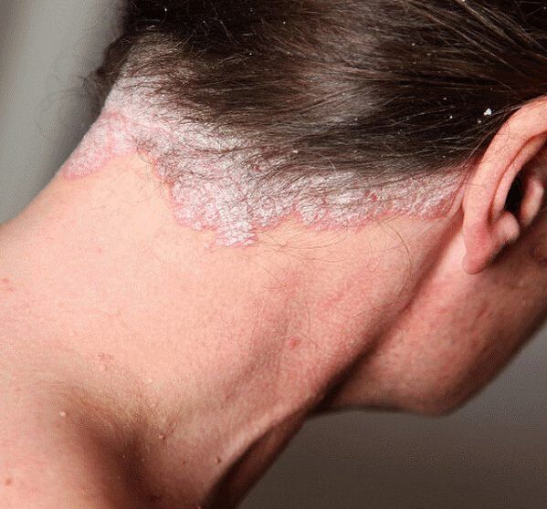 How to treat psoriasis