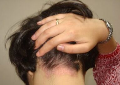 Psoriasis on the head