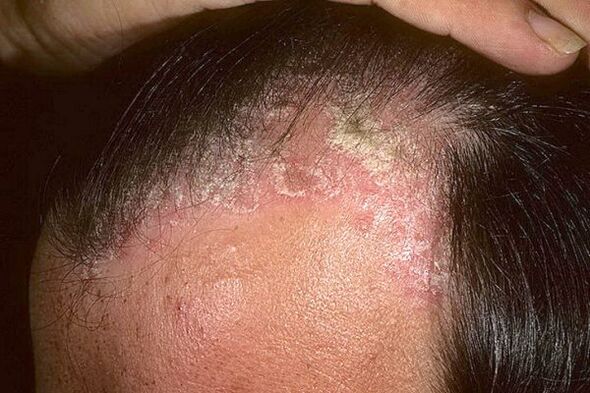 Symptoms of psoriasis